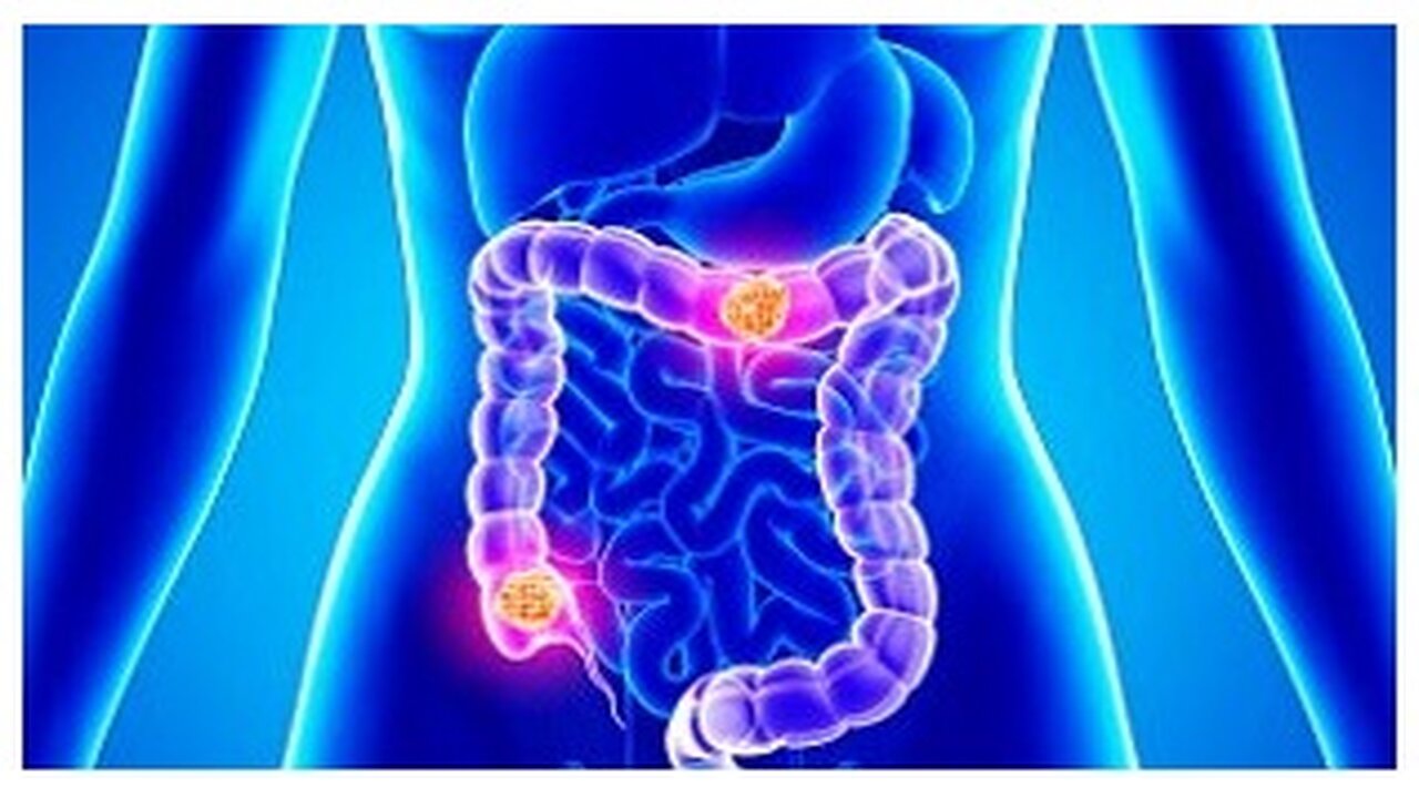 أعراض سرطان القولون المبكر وابرزها الم فى البطن وفقدان الوزن